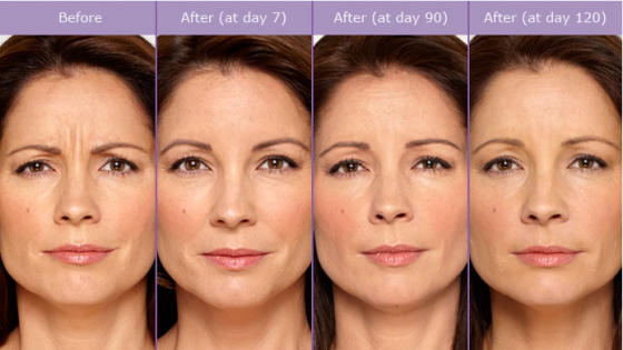 SCG-Skin-Before-After-from-Botox-Alecia