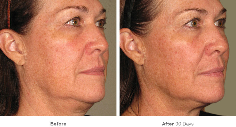 before-after results from Ultherapy