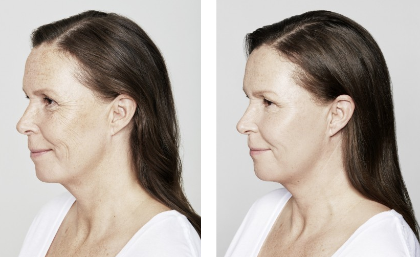 before and after results from Restylane