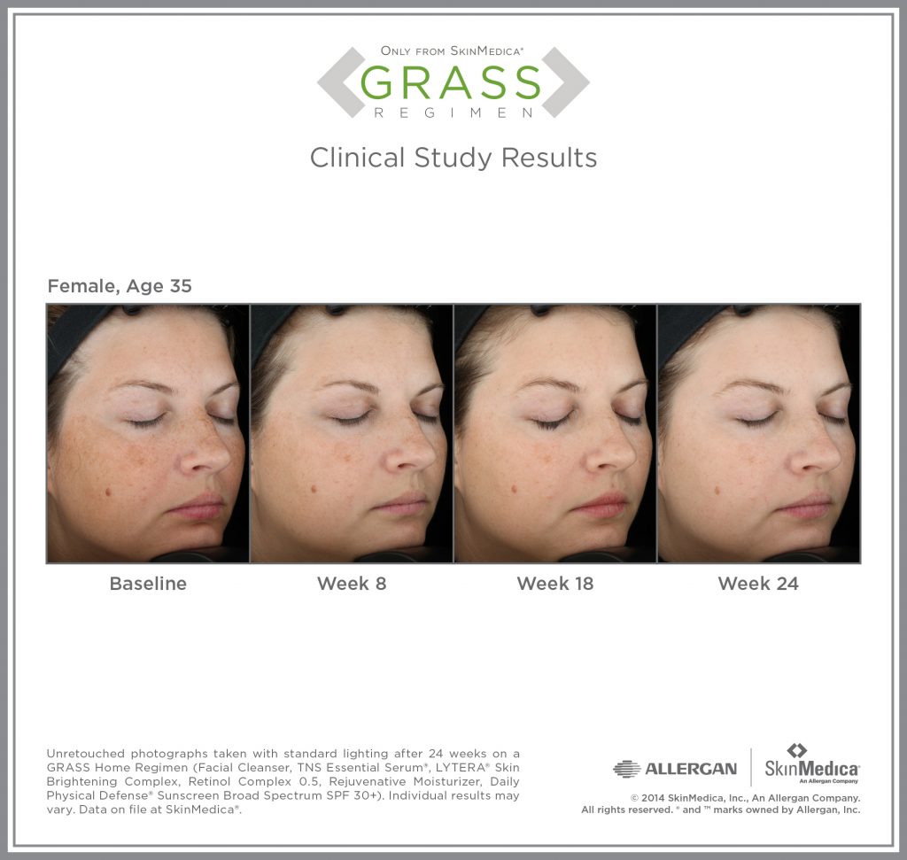 Skinmedica results over a 24 week time period on a female age 35