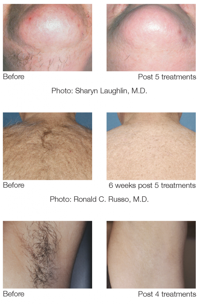 before and after results photos after laser hair removal treatments