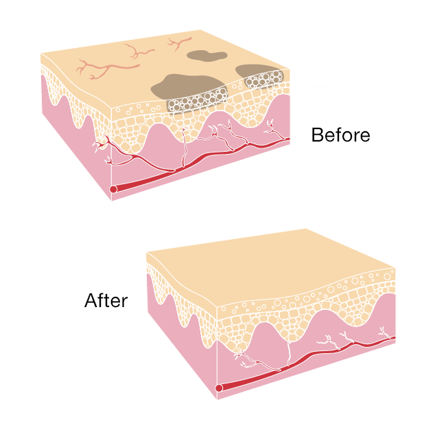 before-after graphic of layers of skin after intense pulsed light (IPL) treatment