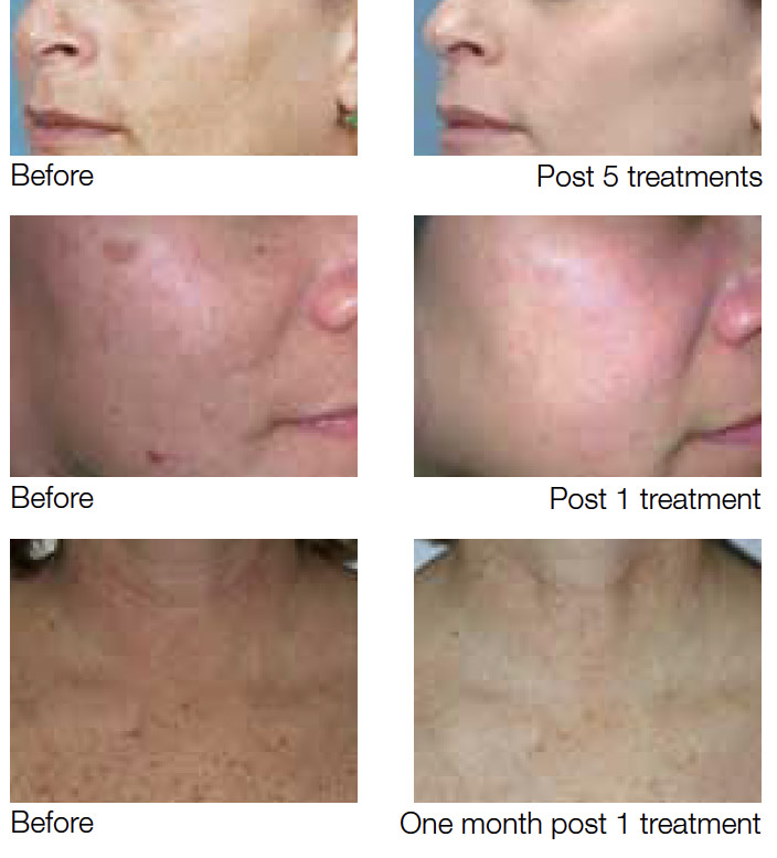 before-after treatment results over time of one treatment, five treatments, and one month of treatment from intense pulsed light (IPL)