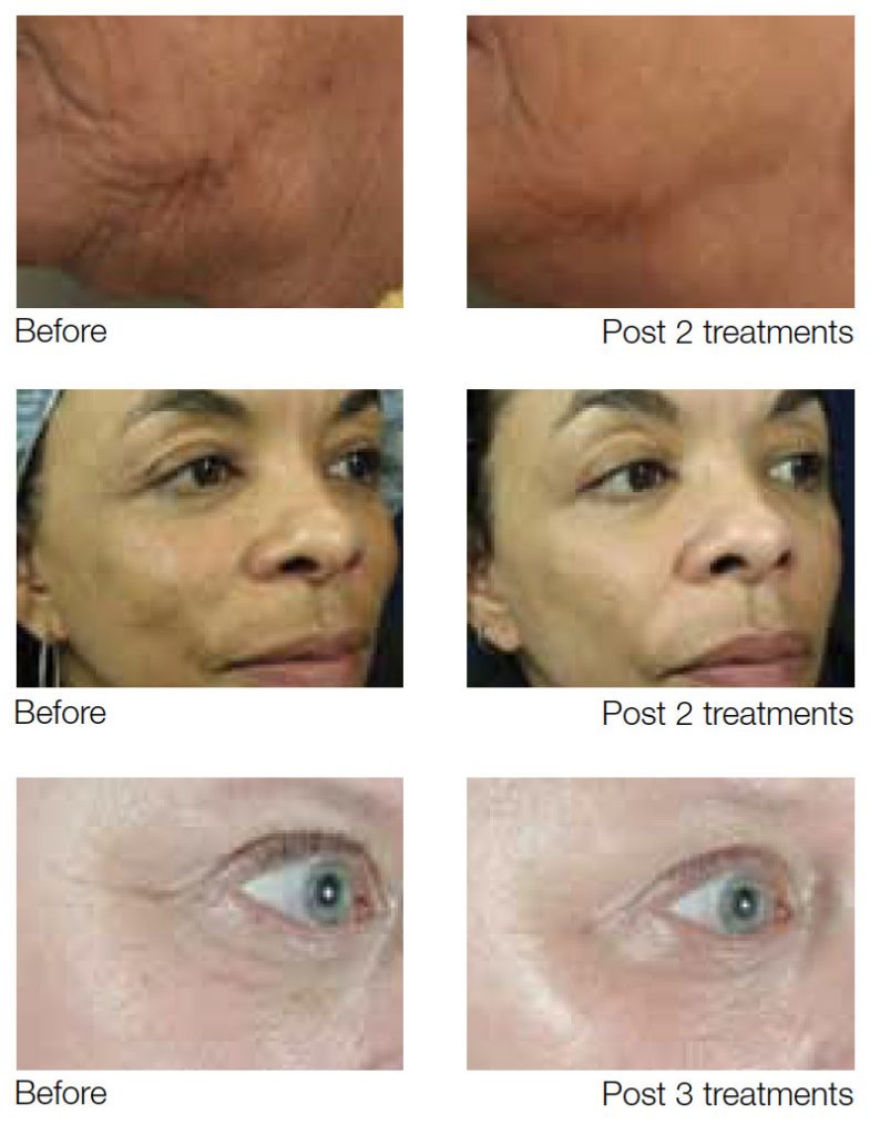 before-and-after photo results of sublative skin rejuvenation